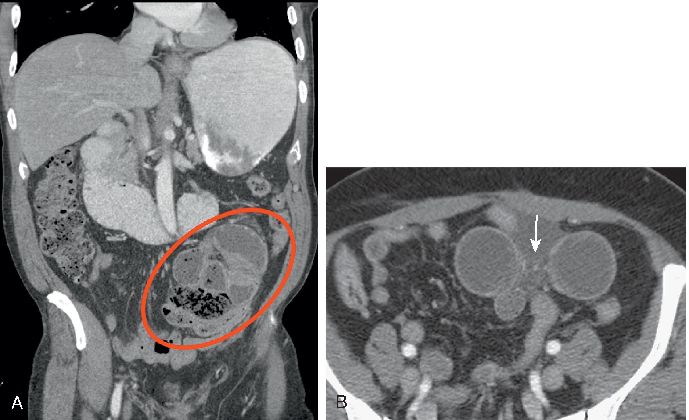 Fig. 67.7, Transmesenteric hernia.