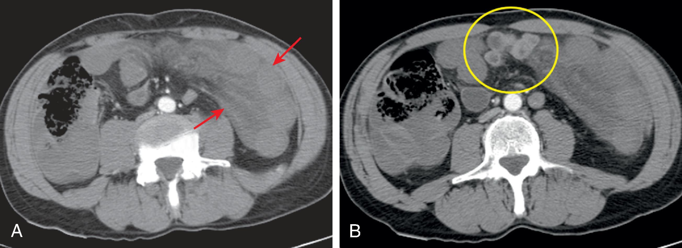 Fig. 67.8, Transomental hernia.