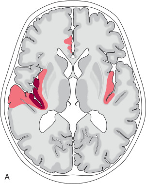 Figure 7.1, Typical MRI features of herpes simplex encephalitis. (A) On presentation there may be unilateral or bilateral asymmetric involvement of limbic system structures, including the temporal lobes, insulae, and cingulate gyri. Restricted diffusion, representing areas of necrosis, is a characteristic feature but not always present. Extensive FLAIR hyperintensity is typically seen. Areas of enhancement or hemorrhage are sometimes seen. (B) Follow-up imaging after several months shows parenchymal volume loss and some residual FLAIR hyperintensity in the regions most severely affected.