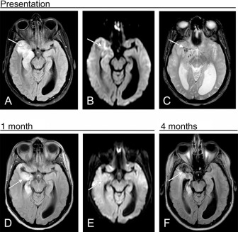 Figure 7.2, Herpes simplex encephalitis, unilateral. (A) FLAIR sequence shows extensive signal abnormality in the right anterior and medial temporal lobe. (B) DWI shows minimal restricted diffusion in the right anterior temporal lobe. (C) Gradient echo (GRE) sequence shows scattered foci of hemorrhage in the right temporal lobe. (D) Follow-up imaging at 1 month shows residual FLAIR hyperintensity with volume loss of the right anterior temporal lobe, with no restricted diffusion on DWI (E). Although the patient had hemorrhage on initial imaging, the small amount of restricted diffusion and rapid initiation of antiviral treatment resulted in a favorable outcome. However, as is often seen even in cases of favorable outcome, follow-up FLAIR sequence at 4 months (F) shows progressive volume loss in the right temporal lobe with cystic change.