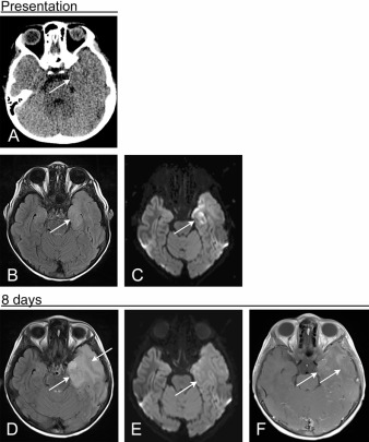 Figure 7.3, Herpes simplex encephalitis with masslike appearance. (A) Noncontrast CT in this 15-year-old immunocompromised patient presenting with encephalopathy shows no abnormality in the left temporal lobe. (B) A FLAIR image performed the same day shows increased signal in the medial left temporal lobe. (C) DWI shows foci of restricted diffusion in the left temporal lobe. (D to F) Follow-up MRI 8 days later shows markedly increased FLAIR hyperintensity (D), with resolution of previously seen restricted diffusion (E). There is associated gyriform cortical enhancement on the postcontrast T1-weighted image (F), typical of herpes simplex virus encephalitis.