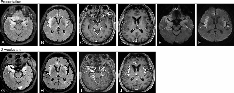 Figure 7.4, Bilateral herpes simplex encephalitis. Elderly female with history of metastatic lung cancer and known brain metastasis presents with mental status change and seizures. (A and B) FLAIR sequences show bilateral but asymmetric signal in both anterior and medial temporal lobes, both frontal lobes (bilateral orbitofrontal cortex and right gyrus rectus) and both cingulate gyri. There is no associated enhancement (C and D). (E and F) DWI sequences show restricted diffusion in the areas of abnormal FLAIR signal, confined to the cortex. Two weeks later, FLAIR signal persists (G and H). (I and J) However, there is now intense cortical enhancement corresponding to the areas of FLAIR hyperintensity. Signal abnormality in the left occipital lobe and left pons is secondary to treated metastatic disease.