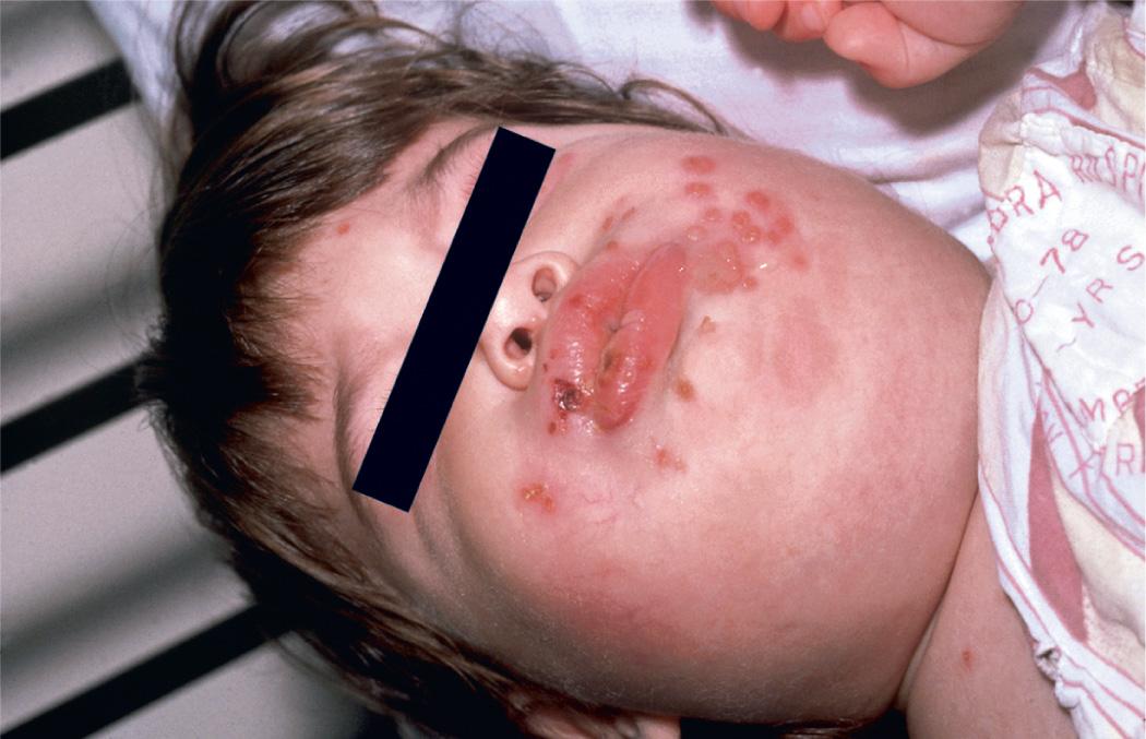 Fig. 279.1, Clustered perioral vesicles and erosions in an infant with primary herpetic gingivostomatitis.