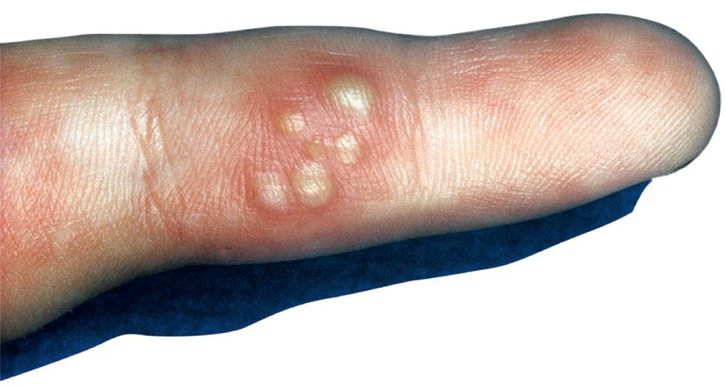 Fig. 279.2, Herpes simplex infection of finger (whitlow).