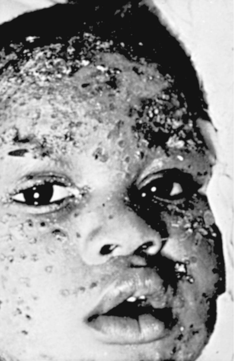 Fig. 279.3, Widespread cutaneous herpes infection in a child with underlying eczema (eczema herpeticum).