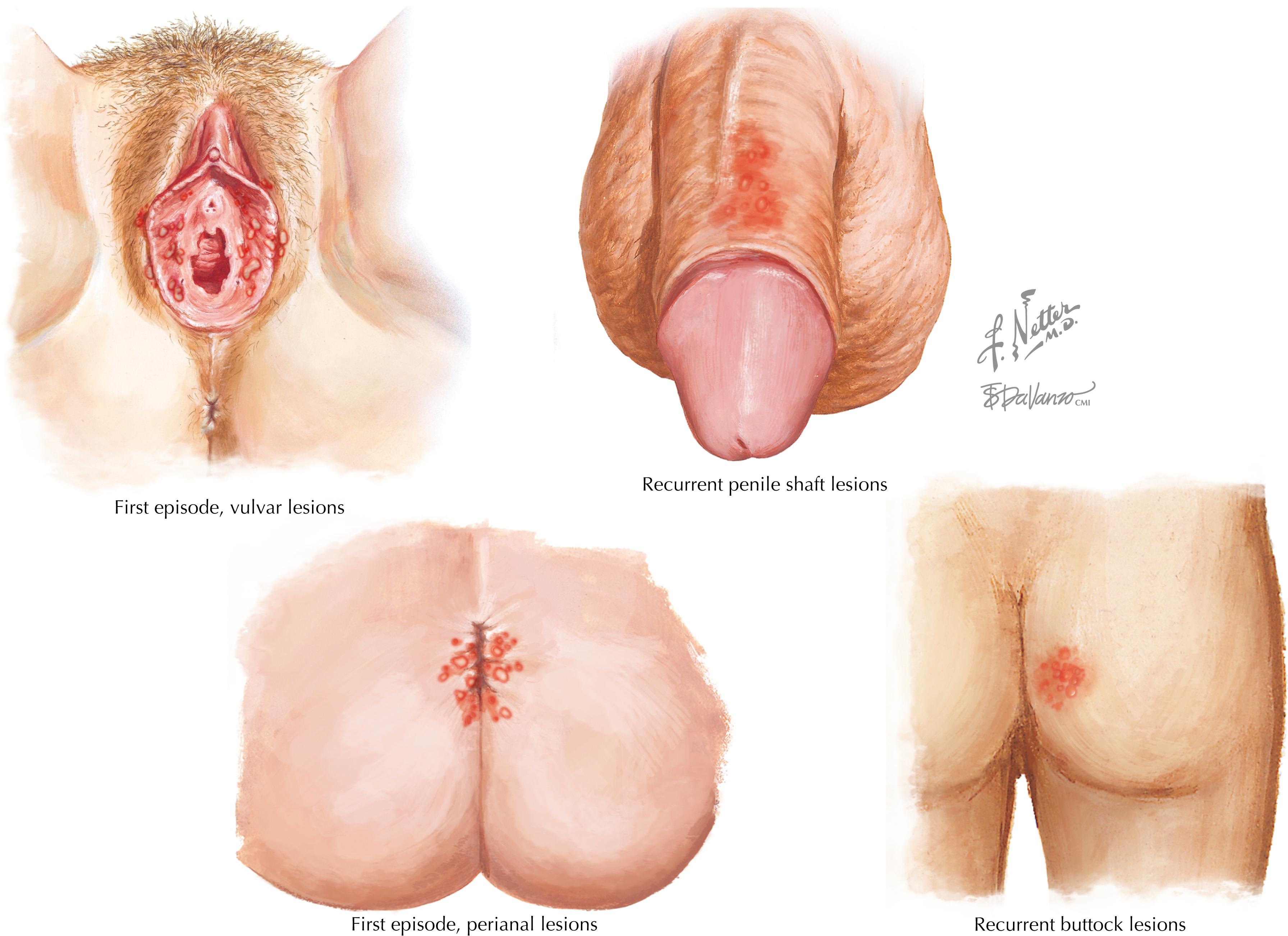 Fig. 55.2, Herpes lesions.