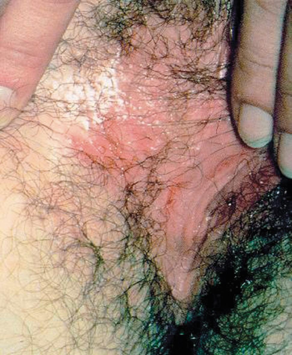 Fig. 23.3, Genital herpes. This is a typical genital herpes recurrence with erythema in the labial folds of a young woman. Genital recurrences are usually painful and may present manifest as bumps, fissures, or vesicles.