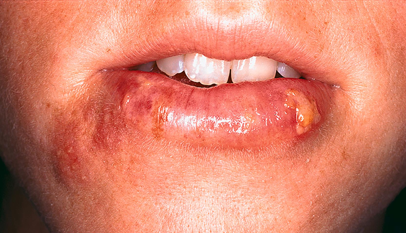 FIGURE 345-1, Herpes labialis, classic grouped blisters.