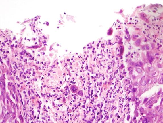 Figure 2-2, Herpes simplex esophagitis. Cells with ground-glass inclusions demonstrating multinucleation, molding, and margination of the nuclear chromatin.