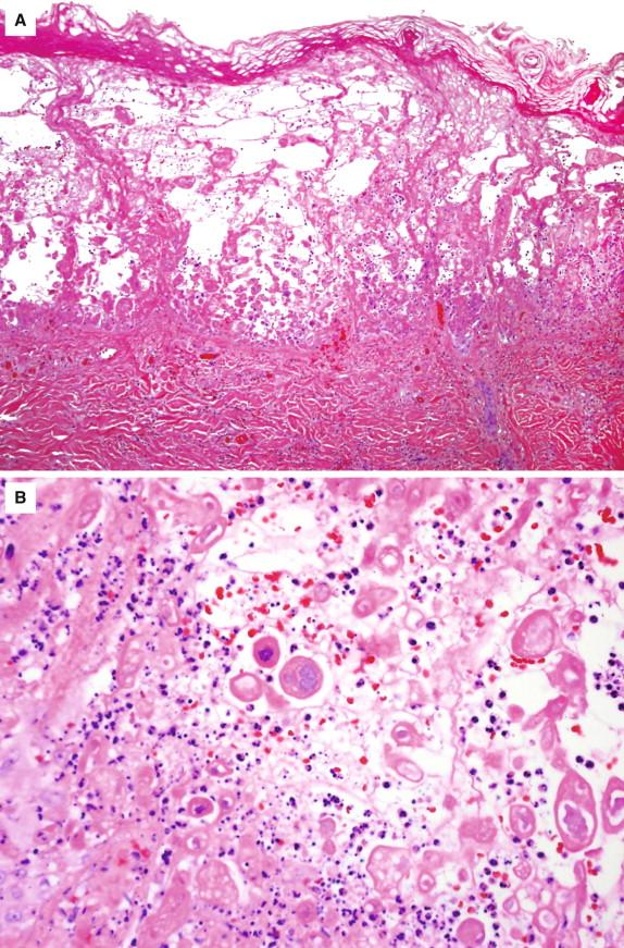 Figure 2-3, Varicella zoster virus. A, This low-power H&E demonstrates blister formation with intraepidermal acantholysis and inflammation. B, A higher-power view demonstrates multinucleation and glassy intranuclear inclusions.