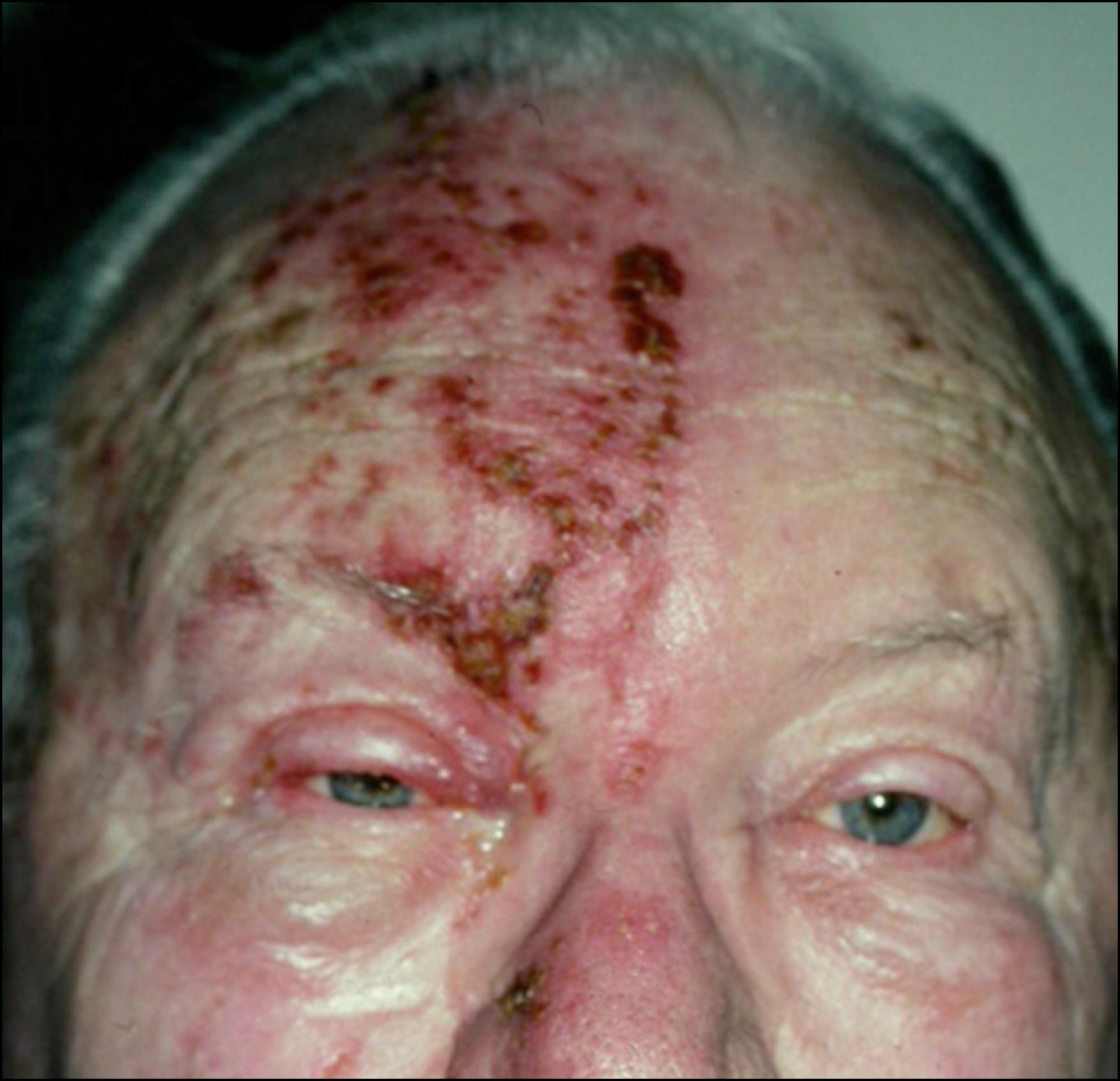 Fig. 79.1, Herpes zoster involving the ophthalmic nerve distribution of the trigeminal nerve. An elderly man with eschars of the forehead, brow, periocular, and nasal skin.