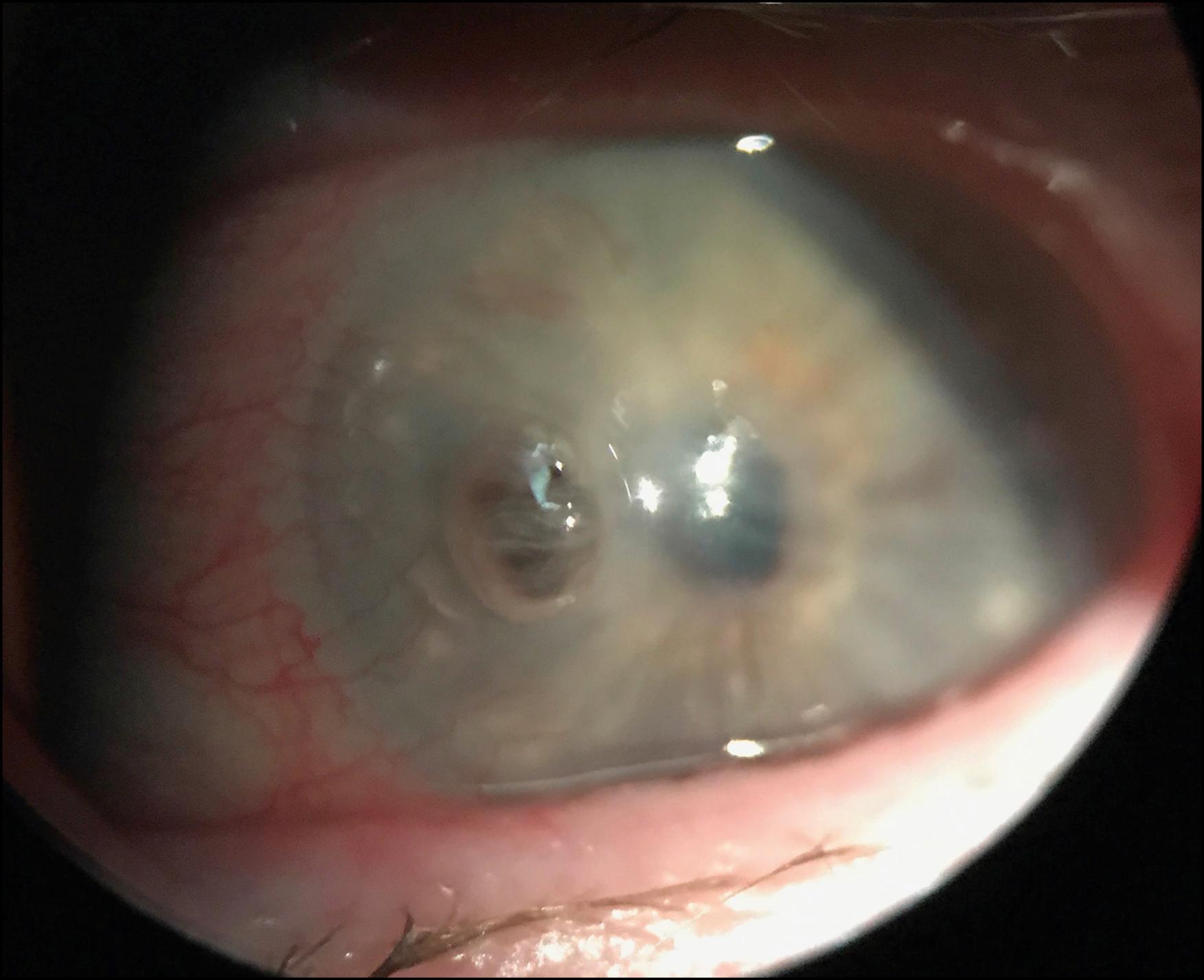 Fig. 79.2, A descemetocele developing from severe untreated herpes zoster neurotrophic keratitis that required urgent keratoplasty.