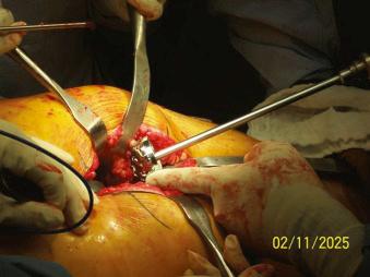 Fig. 86.4, Visualization during reaming is increased when a thinner reamer driveshaft is used. Easily removable reamer baskets allow for placement of the reamer basket into the acetabulum and subsequent attachment of the reamer driveshaft.