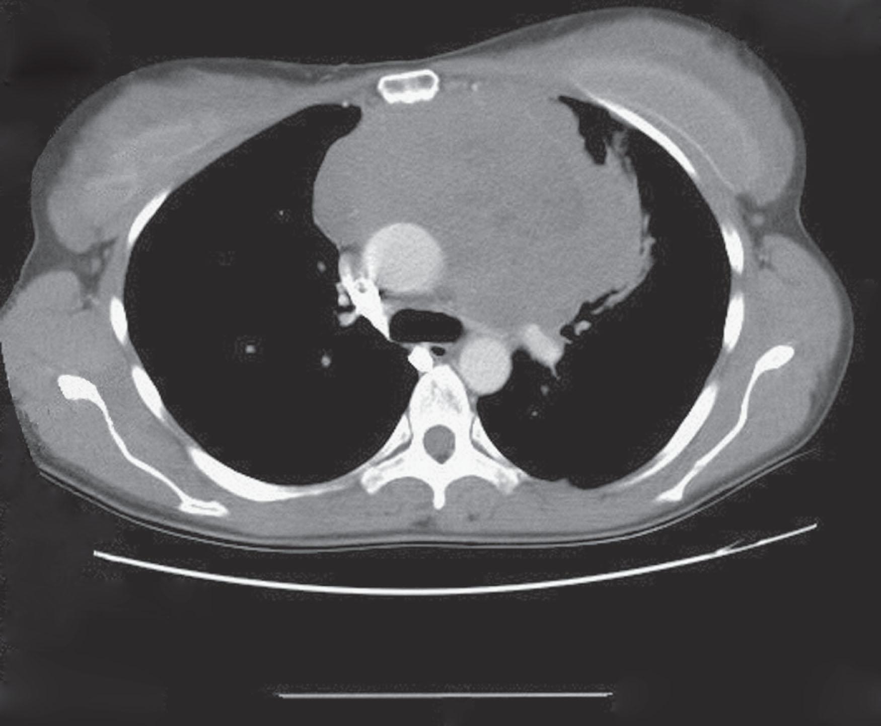 Figure 85.1, COMPUTED TOMOGRAPHY SCAN OF THE CHEST SHOWING A LARGE 17-CM ANTERIOR MEDIASTINAL MASS.