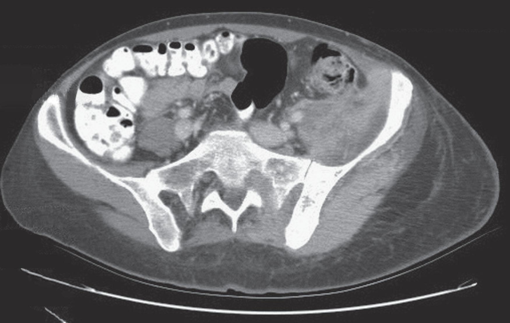 Figure 85.2, COMPUTED TOMOGRAPHY SCAN OF THE ABDOMEN SHOWING A LARGE LEFT-SIDED PSOAS MASS.