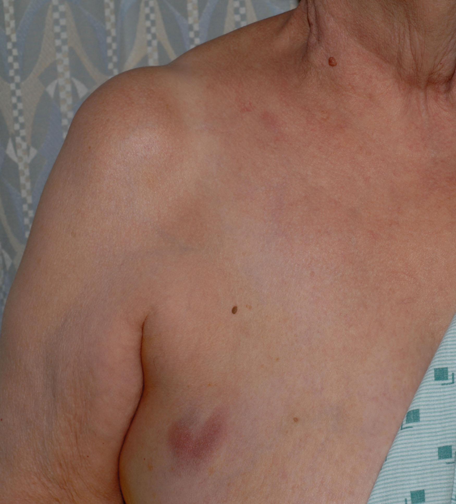 Figure 85.3, INFILTRATION OF THE RIGHT LOWER ANTERIOR CHEST WALL WITH DIFFUSE LARGE B-CELL LYMPHOMA.