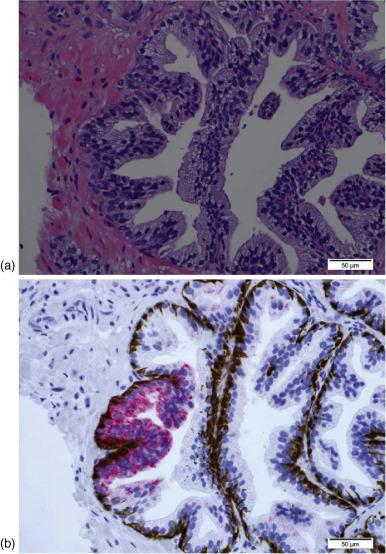 Figure 6.1, High grade prostatic intraepithelial neoplasia.