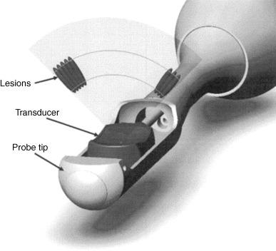 Figure 59.1, Computer-generated rendering of transducer movement and lesion placement.