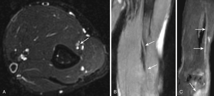 FIG 65-4, Hereditary neuropathy with liability to pressure palsy. Axial T2 SPAIR image ( A ) and oblique coronal T2 GRE PSIF MIP image ( B ) show increased signal in the radial nerve at and distal to the spiral groove of the humerus (arrows). C, Oblique coronal DTI MIP image shows the hyperintense radial nerve and the resulting extensor compartment muscle edema (arrows) indicating denervation changes.