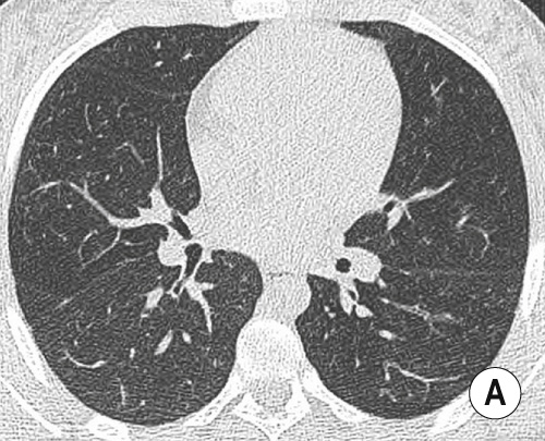 Mosaic attenuation in a patient with bronchiectasis in the lower lobes (not shown). HRCT image taken in inspiration (A) shows subtle mosaicism, emphasized in the section acquired at end-expiration (B), indicating small airways disease. **