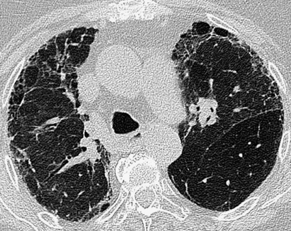 Usual interstitial pneumonia. In the upper lobes anteriorly there are peripheral irregular lines with areas of honeycombing. *