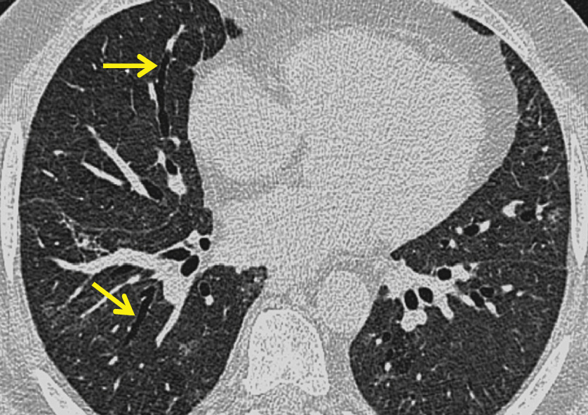 There is generalized ground-glass opacification and a few thickened interlobular septa. There is marked dilatation of the bronchi (arrows) reflecting the presence of fine interstitial fibrosis. Biopsy-proven non-specific interstitial pneumonia. ©2