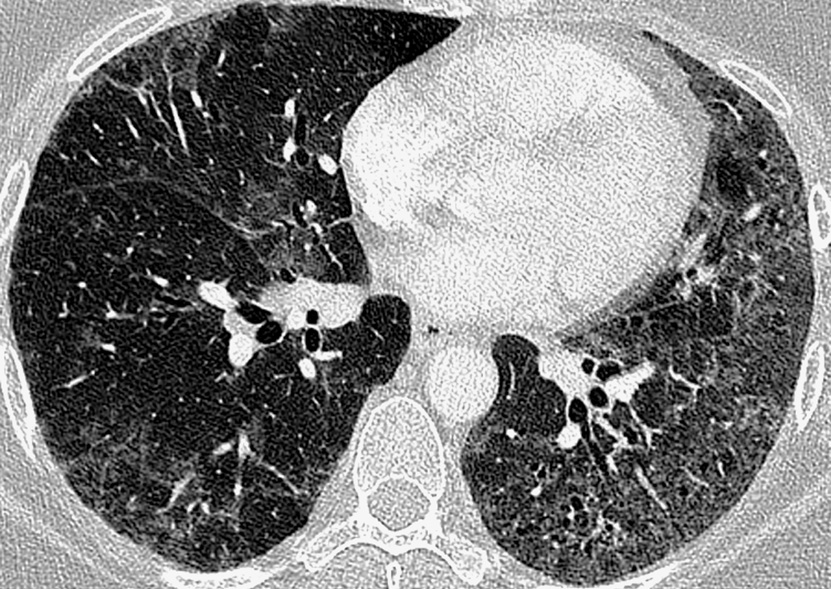 Non-specific interstitial pneumonia. The predominant abnormality is patchy, bilateral ground-glass opacification, mild reticulation and traction bronchiectasis. There is no frank honeycombing destruction. *