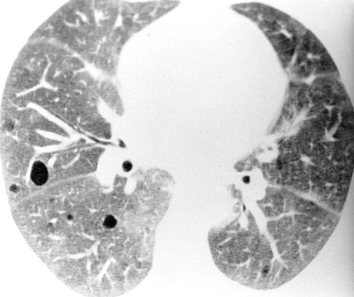 Lymphocytic interstitial pneumonitis. There is a background of ground-glass opacification and a few thin-walled cystic airspaces (the pathogenesis of these cysts is unclear). *