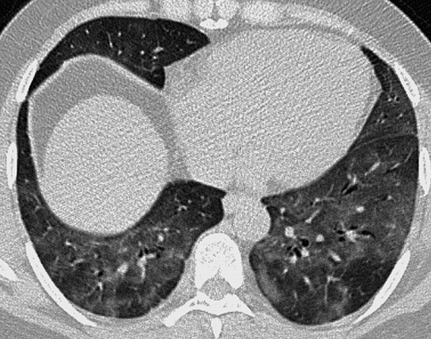 Widespread ground-glass opacification in a patient with desquamative interstitial pneumonia. The pulmonary vasculature is not obscured by this degree of opacification and the air-filled bronchi not unduly dilated. ©2