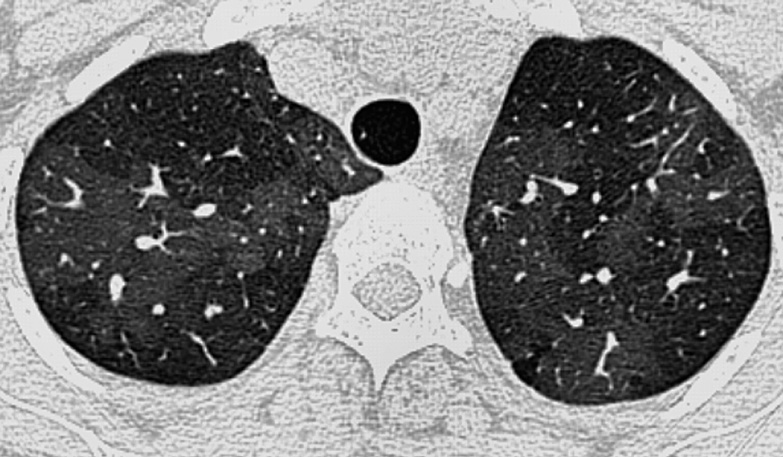 Mosaic attenuation in the upper lobes of a patient with sickle cell disease and pulmonary hypertension. Note the increased calibre of the vessels within the increased attenuation (lighter) lung compared with the decreased attenuation (darker) parts of the lung, suggesting a vascular cause of the mosaic attenuation pattern in this case. ©2