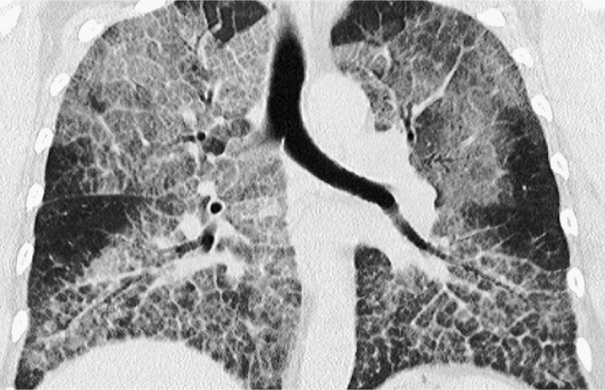 Widespread smooth thickening of the interlobular and intralobular septa in areas of ground-glass opacification in a patient with pulmonary alveolar proteinosis. ©2