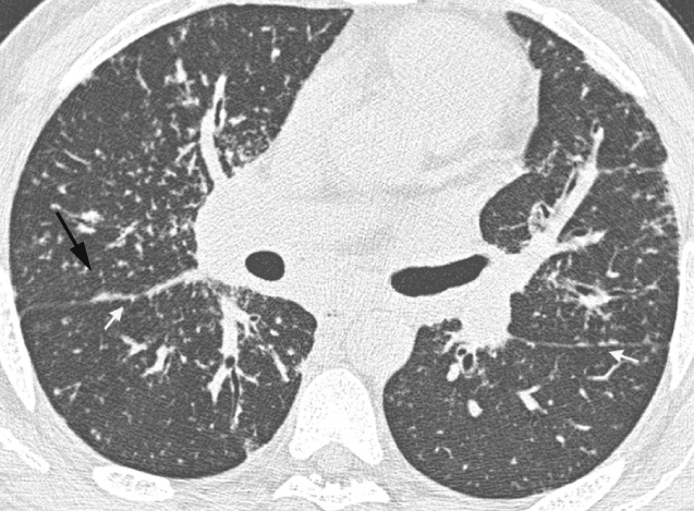 Nodular pattern: HRCT showing scattered nodules within the lung interstitium in a peribronchovascular distribution, with beading along the fissures (arrows) in a patient with pulmonary sarcoidosis.