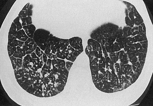 Marked thickening of the interlobular septa with randomly distributed small nodules in an individual with silicosis. ©2