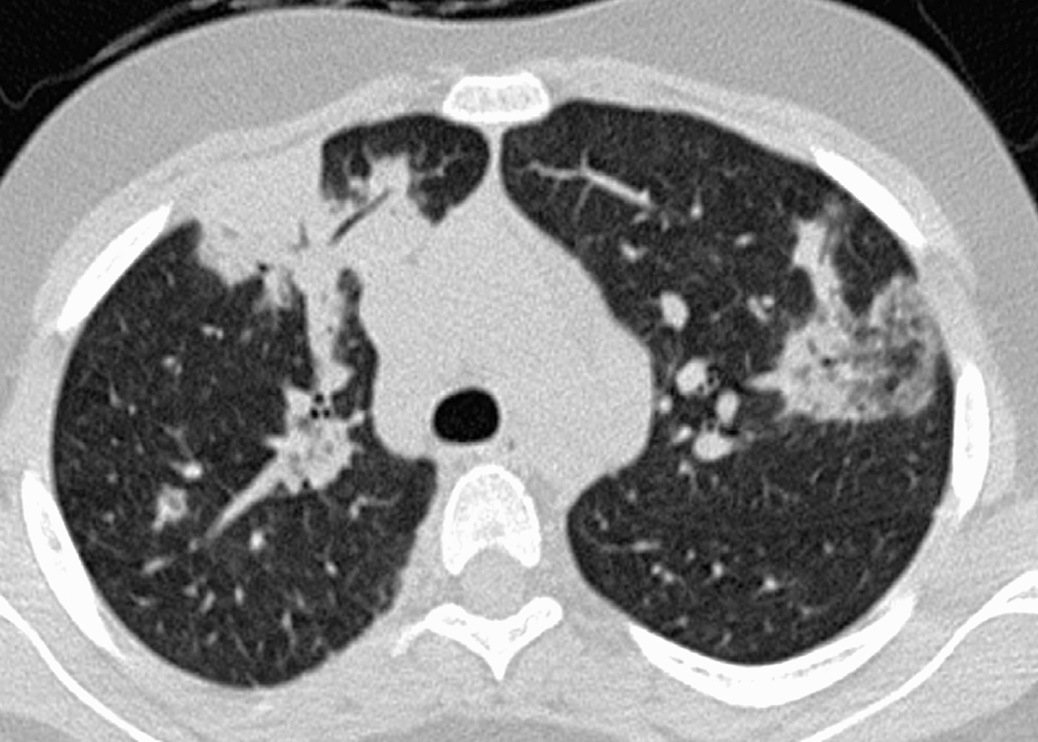 Cryptogenic-organizing pneumonia. HRCT through the upper lobes demonstrates areas of consolidation in a subpleural and peribronchial distribution in association with areas of ground-glass opacification (left upper lobe). *