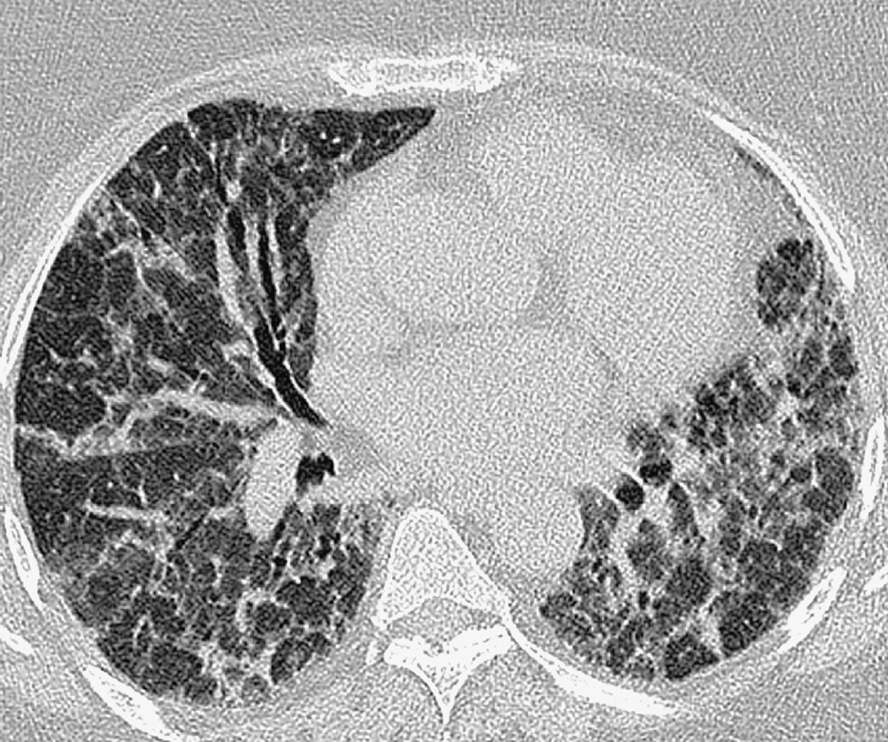 Biopsy-proven-organizing pneumonia. There are poorly defined arcade-like and polygonal opacities (the perilobular pattern) in the subpleural and posterior regions of both lungs. The opacities resemble ill-defined thickened interlobular septa. *