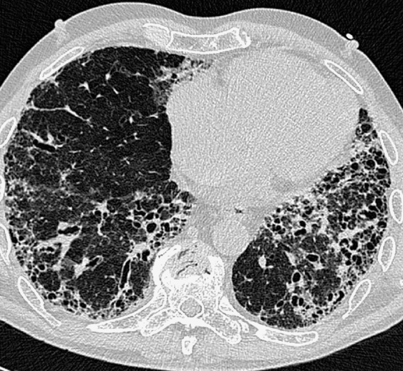 Usual interstitial pneumonia. HRCT abnormalities predominate in the posterior, and subpleural regions of the lower lobes and comprise honeycombing and traction bronchiectasis within the abnormal lung. *