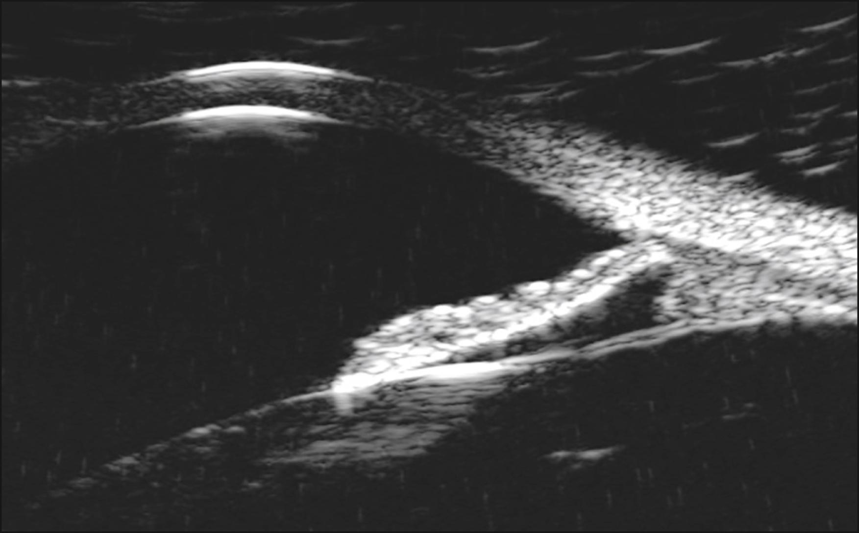 Fig. 16.6, Longitudinal scan through angle.
