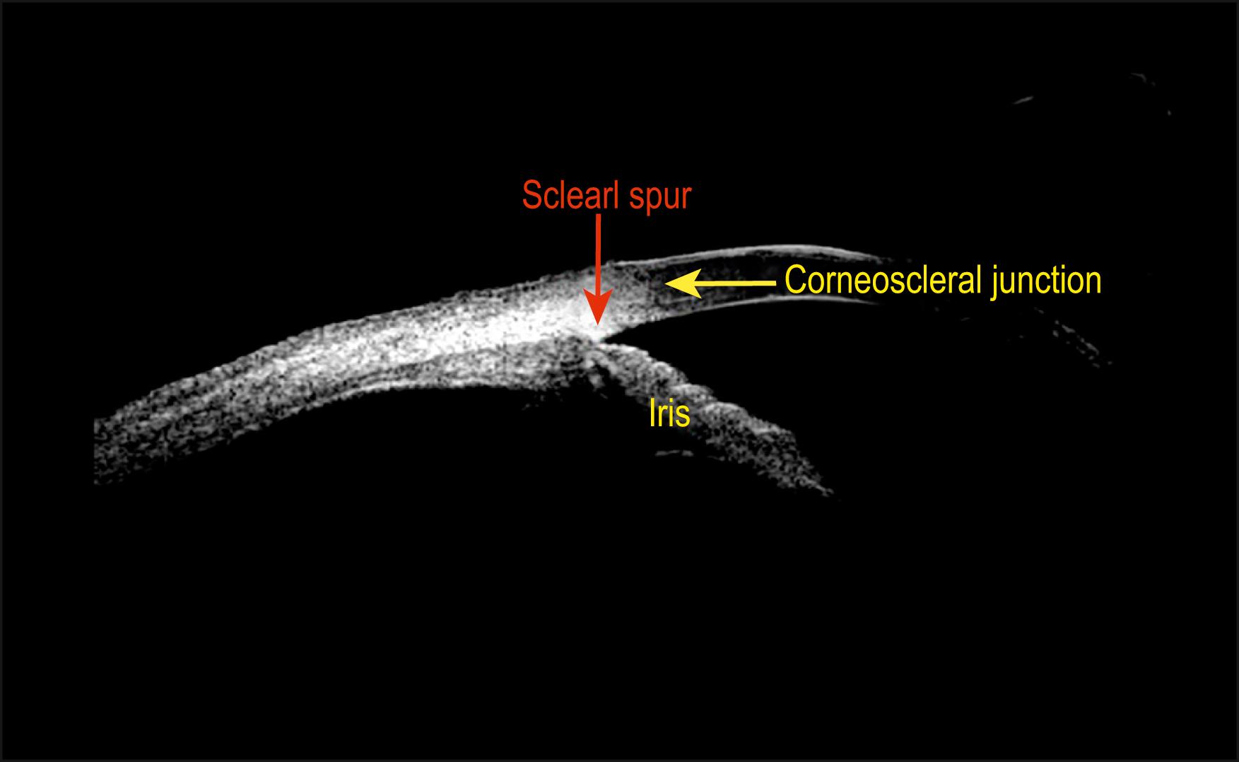 Fig. 16.8, Scleral spur and corneoscleral junction.