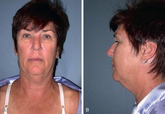 FIGURE 11.1, A 57-year-old woman who thinks she looks older than her age and doesn't like her heavy neck.