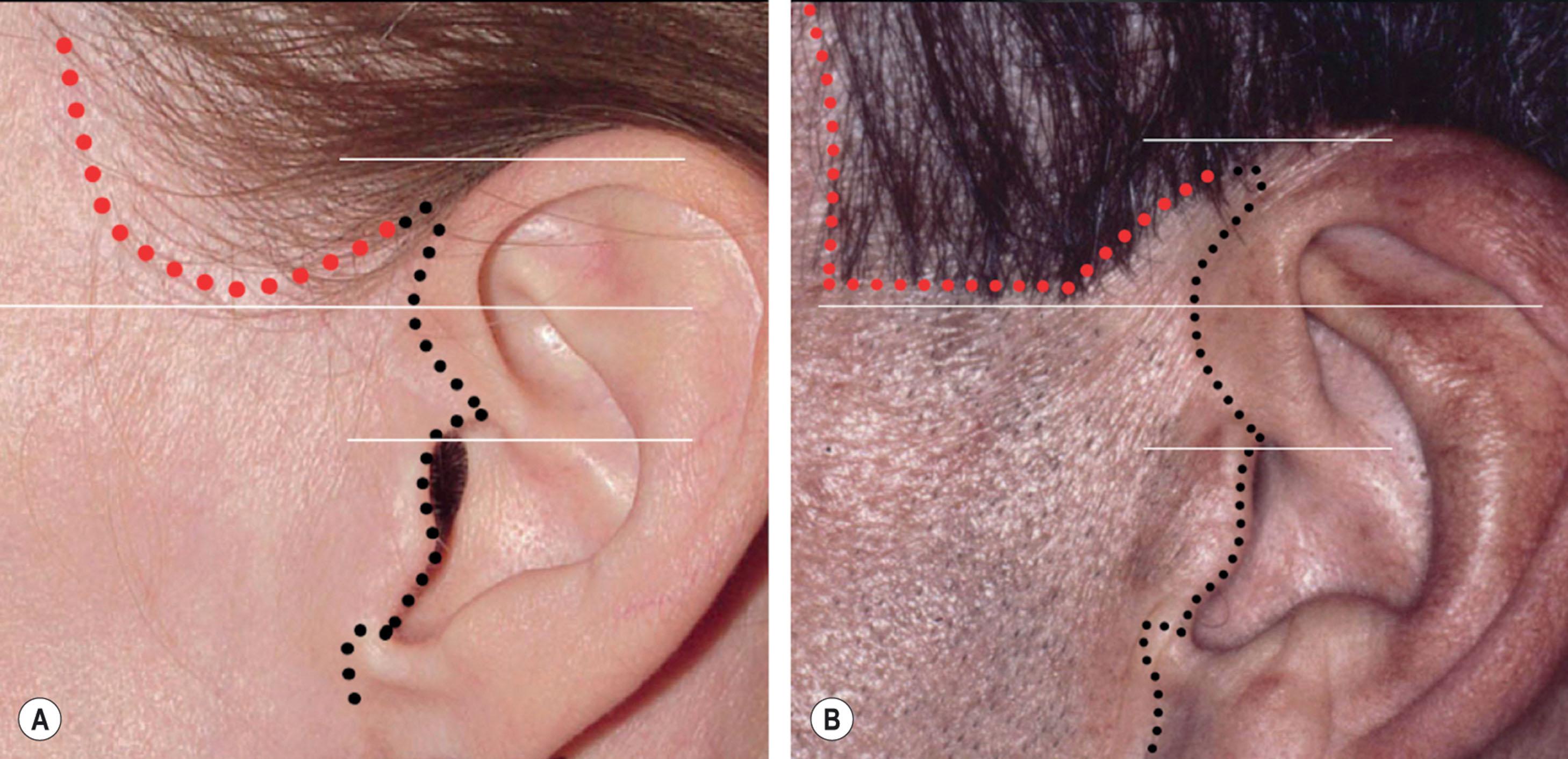 Figure 9.8.10, Plan for incision along the temporal hairline – female vs. male patients. An incision along the temporal hairline should be considered whenever the surgeon’s assessment predicts objectionable superior and posterior displacement of the sideburn and temple hair will occur. This incision plan is usually indicated in older patients and almost always in patients undergoing secondary or tertiary procedures. In certain cases the incision may extend higher or lower than shown depending on the amount of excess skin present in the upper lateral face. (A) Temple hairline incision plan for the female patient (dotted red line). Note that incision is planned as a soft curve to evoke a feminine appearance extending inferiorly to a point approximately half the height of the anterior helix (solid white lines). (B) Temple hairline incision plan for the male patient (dotted red line). Note that incision is planned with a more rectangular masculine shape extending inferiorly to a point approximately half the height of the anterior helix (solid white lines). Dotted black lines show typical position of pre-auricular incisions. (An incision plan that sets the male sideburn more inferiorly than shown may compromise the blood supply to the prehelical part of the facelift skin flap. Such a plan also requires the patient to wear a long sideburn from their surgery date forward if the scar is to not show.)