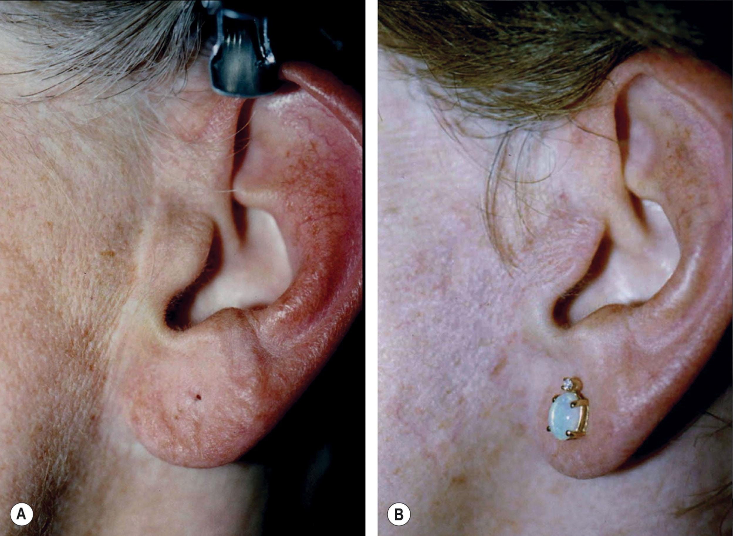 Figure 9.8.12, Pretragal and concealed (“retrotragal”) scars compared. (A) Pretragal incision has healed satisfactorily with an acceptable scar but is visible due to differences of color and texture on each side of it and exists as a tell-tale sign that a facelift has been performed. (Surgery performed by an unknown surgeon.) (B) Same patient after secondary facelift in which the incision was moved to the posterior margin of the tragus (“retrotragal” position). Color and texture differences, and the scar itself, are now hidden along natural anatomic interfaces and a tell-tale sign that a facelift has been performed is not present. (Surgery performed by Timothy Marten, MD, FACS.)