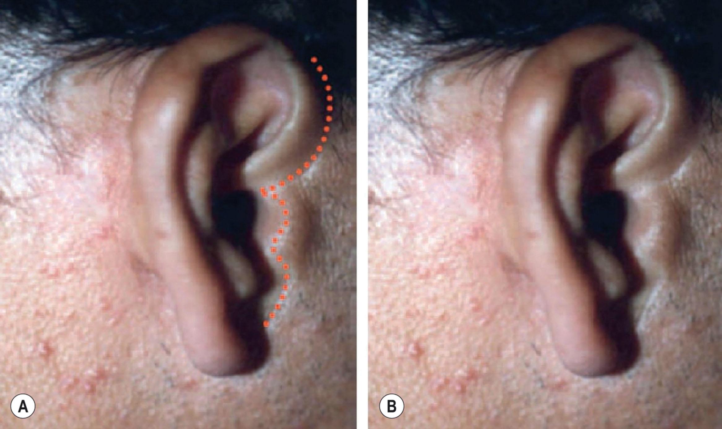 Figure 9.8.17, Optimal position of the pre-auricular incision. (A) Placing the pre-auricular scar along natural anatomic interfaces (red dotted line) places transitions of color and texture in locations where the eye is expecting to see them concealing them, and the scar itself if seen will appear as a reflected highlight (see Fig. 9.8.17B ) (B) Note that the scar although hypopigmented and situated on darker skin and visible, appears to the eye to be a reflected highlight along the anterior border of the helix and the posterior margin of the tragus, and elsewhere where the incision was made. Note also how gradients of color and texture on each side of the scar appear expected and natural. A similar illusion and concealment would not be present had the incision been placed in a pretragal location.