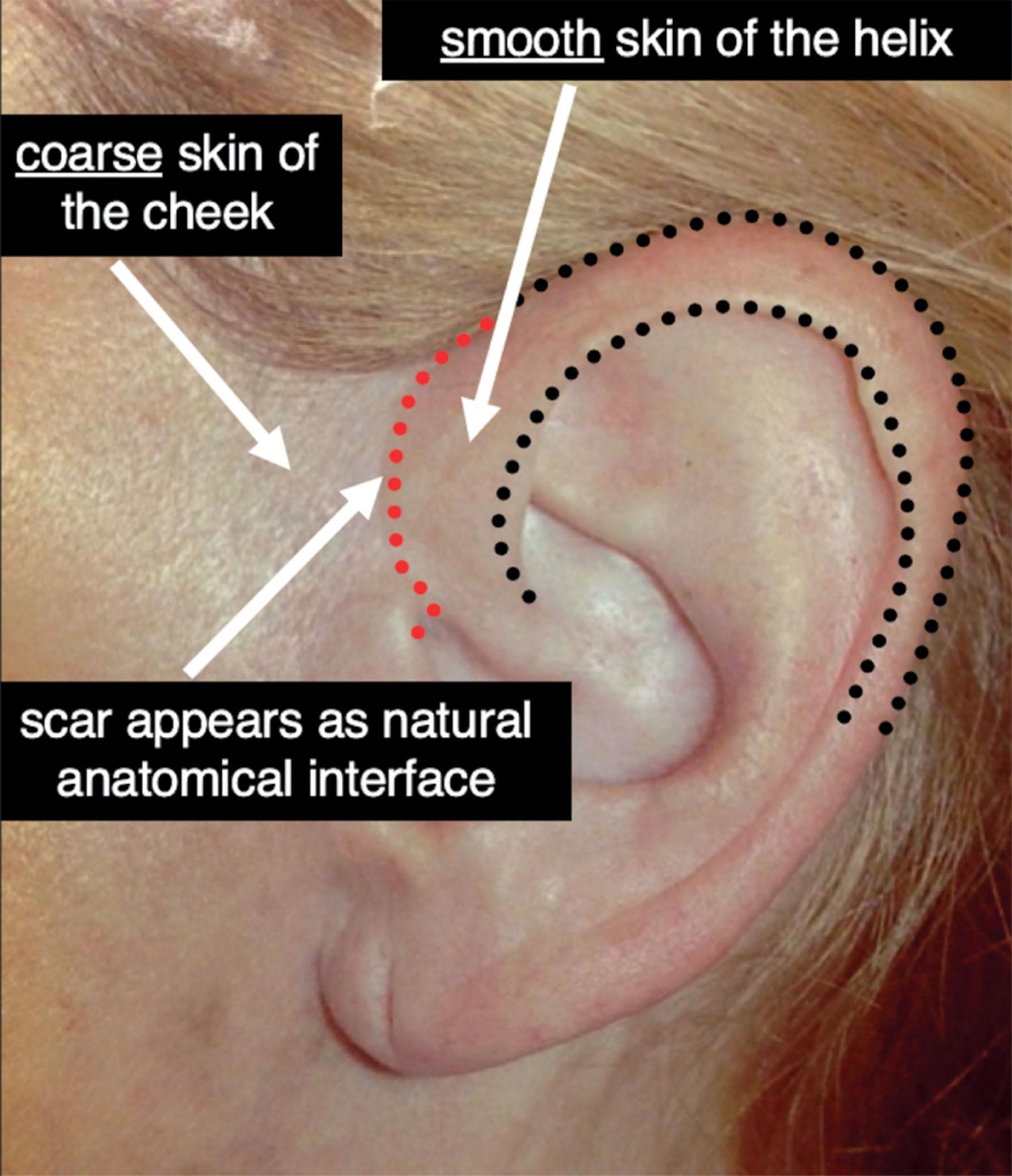 Figure 9.8.15, Optimal position of prehelical part of the pre-auricular incision. The prehelical portion of the pre-auricular incision (red dotted line) should be planned as a soft curve paralleling the curve of the anterior border of the helix. This will result in a natural-appearing “width” to the helix in keeping with the rest of the ear (black dotted lines) and the resultant scar, if visible, will appear to be a helical highlight and be disguised as the natural transition between the smooth pinker skin of the helix and the coarser paler skin of the cheek.