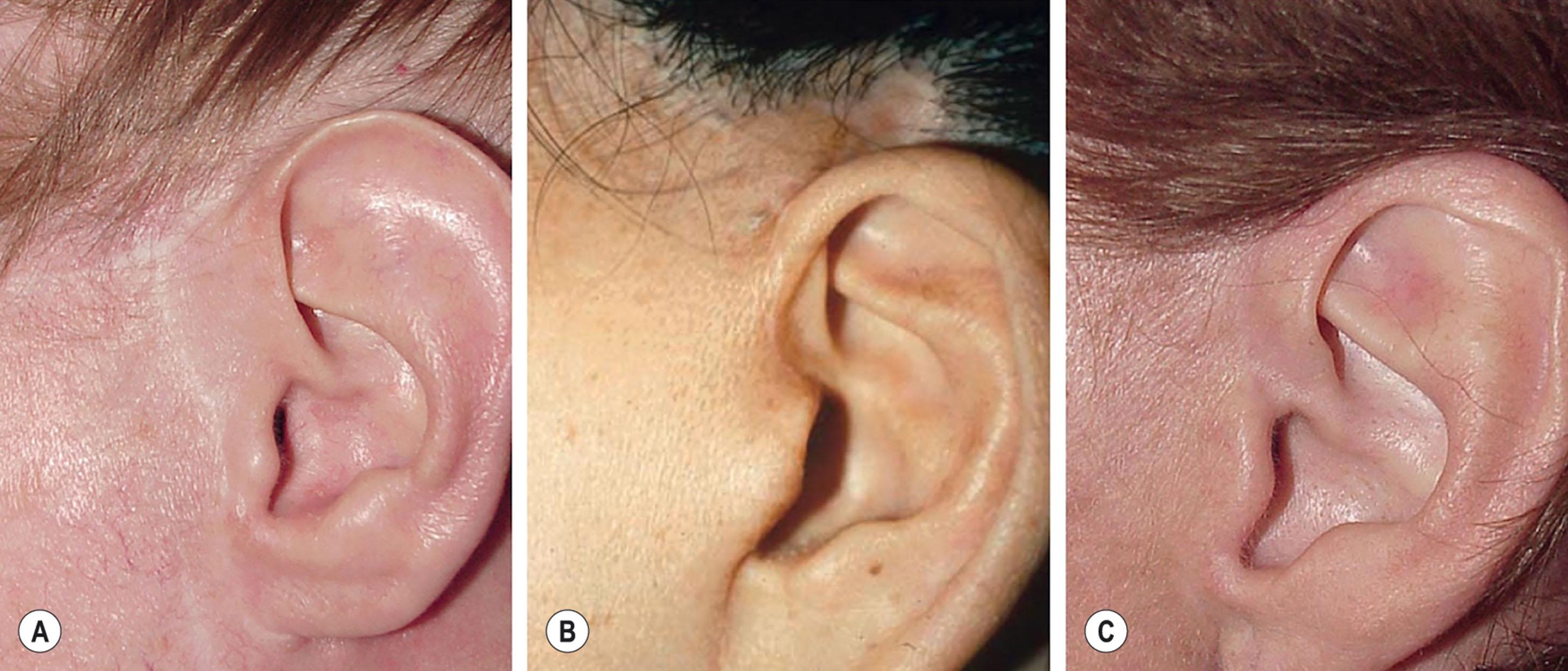 Figure 9.8.16, Improper and proper placement of prehelical scar. Often the prehelical portion of the pre-auricular scar is poorly situated, and the illusion of it as an anatomic feature is lost. (A) The prehelical incision has been made too far anteriorly, and the illusion of the scar as an anatomic feature is lost. (Surgery performed by unknown surgeon.) (B) The prehelical incision has been made too far posteriorly and has obliterated the helical–facial sulcus and cheek skin has encroached on part of the helix itself. (Surgery performed by unknown surgeon.) (C) A patient with a properly planned and executed prehelical incision. The scar has been placed directly in the helical–facial sulcus. In this location a transition of color and texture is expected, and the scar appears to be a natural anatomic feature (see also Figs. 9.8.12–9.8.14 ). (Surgery performed by Timothy Marten, MD, FACS.)