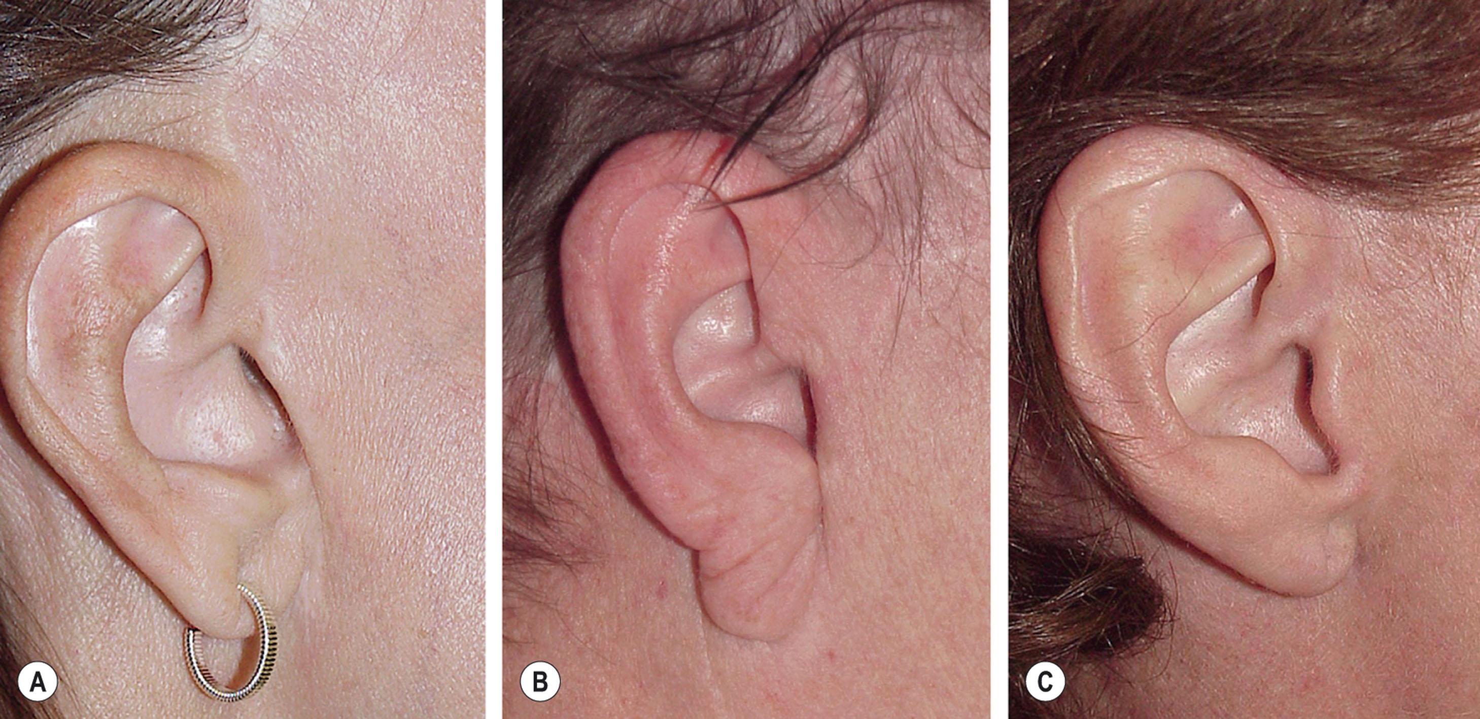 Figure 9.8.18, “Chopped-off” tragus. (A,B) The unnatural and objectionable appearing, elongated tragus with an indistinct inferior border that results from poor incision planning, improper excision of skin at the time of incision closure, and failure to provide SMAS support of deep player facial tissues. (Note also unaesthetic and objectionable displacement of sideburn hair due to improper planning of the temporal portion of the facelift incision as well.) (Procedures performed by unknown surgeons.) (C) Natural-appearing tragus following proper incision planning, excision of skin, and diversion of tension to the SMAS layer. (Procedure performed by Timothy Marten, MD, FACS.)