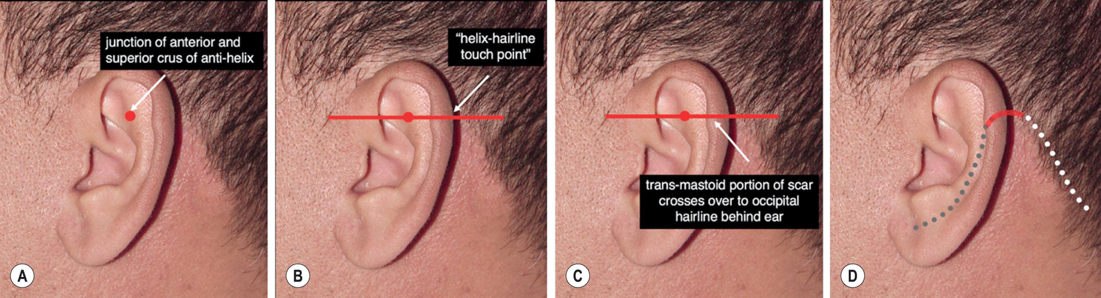 Figure 9.8.20, Planning the position of the transmastoid part of the postauricular incision. Strategically placing the transmastoid part of the postauricular incision conceals it and allows optimal excision of skin from the anterior neck. If it is placed too low it is visible when the patient’s hair is worn up or if they wear a short hairstyle. If it is placed too high the defect created will force and overly vertical shift of the postauricular skin flap and compromise improvement in the neck (see also Fig. 9.8.19 ). (A) The point of divergence of the anterior and superior crus of the helix provides a useful guide as to how high the transmastoid part of the postauricular incision should be placed (red dot). (B) At this horizontal level (red line) the rim of the helix will typically “touch” the occipital hairline in the lateral view. (C) A transmastoid scar placed at this level will cross over to the occipital scalp in a hidden location. Note that if the incision were placed lower the resulting scar would show. (D) Typical plan for the postauricular incision showing the transmastoid component (red line) to be concealed (gray dotted line shows location of the conchomastoid component incision hidden behind the ear and white dotted line the occipital incision hidden along the occipital hairline). (Note: the patient shown in Fig. 9.8.20A–D has undergone a previous facelift and it can be seen that his scars are well concealed despite his very short “military style” haircut.)