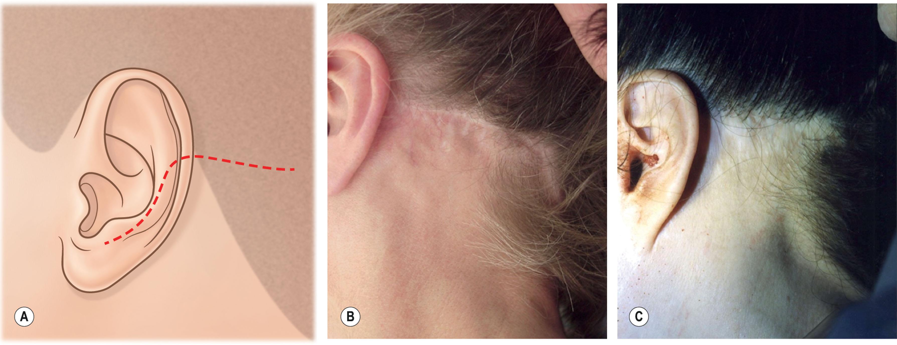 Figure 9.8.21, Traditional plan for the occipital portion of the postauricular Incision. (A) The incision is placed low transversely across the mastoid extending into the occipital scalp in a well-intended but usually counterproductive attempt to hide the resultant scar. This incision should only be used in younger patients for access to the lateral neck only, and cannot be used to remove excess neck skin without producing hairline notching if the postauricular skin flap is shifted along a proper posterior-superior vector. (B,C) Examples of hairline displacement caused by inappropriate use of the incision plan shown in (A). (Procedures performed by unknown surgeons).