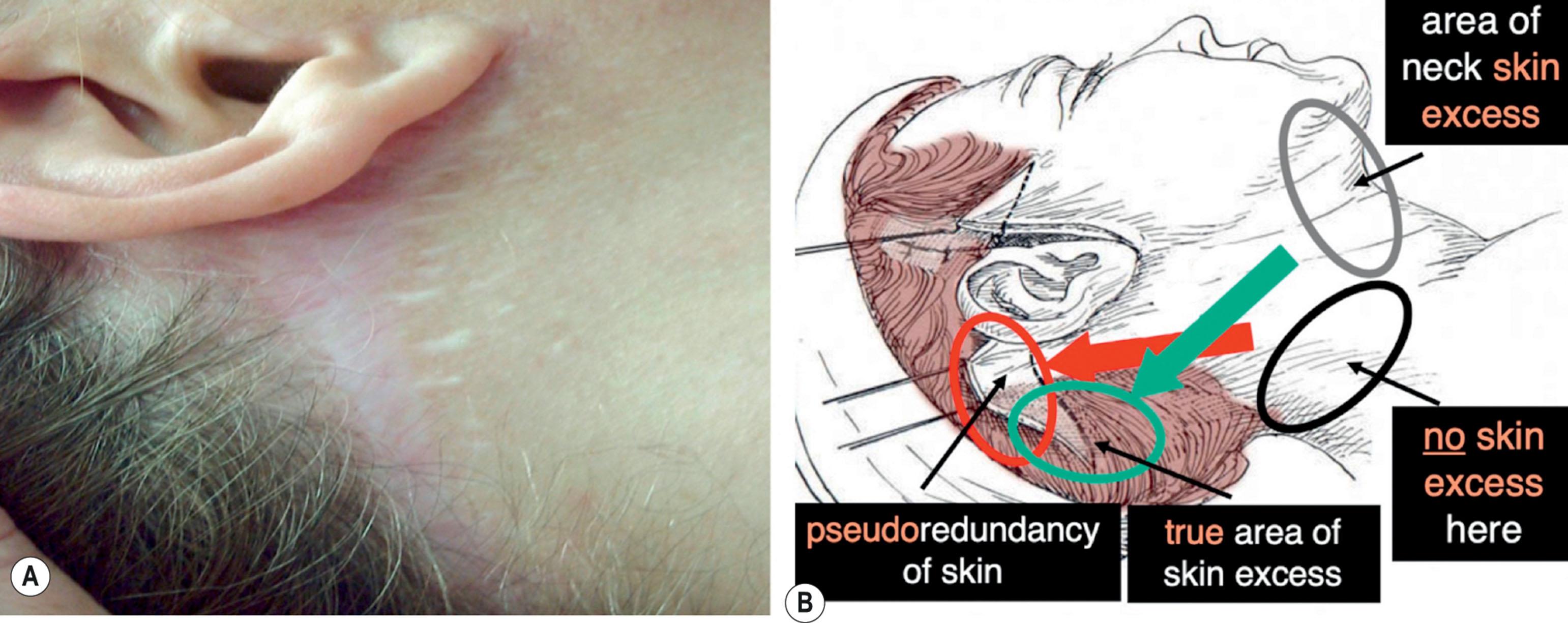 Figure 9.8.23, Understanding the cause of a wide and hypertrophic postauricular scar. (A) An example of avoidable postauricular scar widening and hypertrophy seen in a patient whose surgeon inappropriately excised skin along a superiorly directed vector (see red arrow in (B)). (Procedure performed by unknown surgeon.) (B) Deconstruction of the scar widening and hypertrophy seen in (A). The surgeon made a well-intended, but conceptually flawed attempt to advance the postauricular skin flap along a superiorly directed vector (red arrow), typically in an effort to avoid occipital hairline displacement and reconstitute the occipital hairline. This erroneously assumes excess skin is present in the lower lateral neck (black circle) and produces a false apparent redundancy of skin over the mastoid (skin shown in red circle) due to the elevated position of the patient’s shoulder while lying supine on the operating table. When the patient assumes an upright position postoperatively and the shoulder drops, a skin deficit is created and traction of the wound produces a wide and hypertrophic scar (see (A)). Gray circle shows actual area of neck skin excess and green arrow the proper vector of skin flap advancement if optimal improvement in the anterior neck and submental region is to be obtained. The green circle denotes the area where skin actually should be excised (along an occipital hairline incision). No skin should be excised in the area of the red circle.