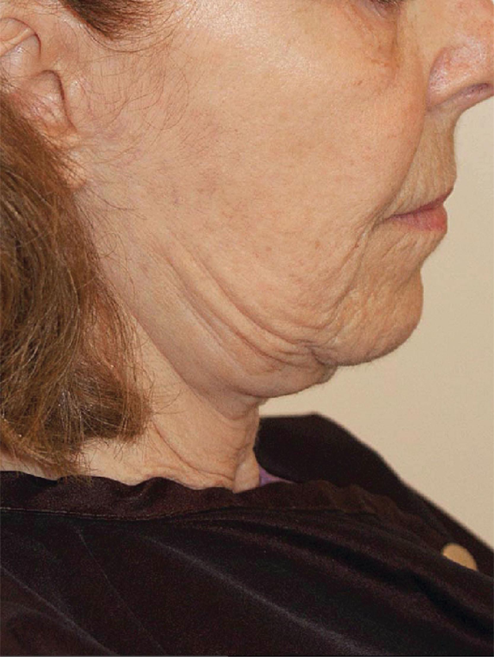 Figure 9.8.4, Lateral sweep. Traditional “skin-only” facelifts and “low SMAS” procedures typically result in over-tightening of the pre-auricular cheek skin and provide little support of the lateral perioral and jowl areas. In time, these unsupported tissues continued to descend in a disproportionate fashion while the lateral face remained tight, resulting in a characteristic and objectionable “swept up” appearance of the skin over the jawline often referred to as “lateral sweep”. (Procedure performed by an unknown surgeon.)