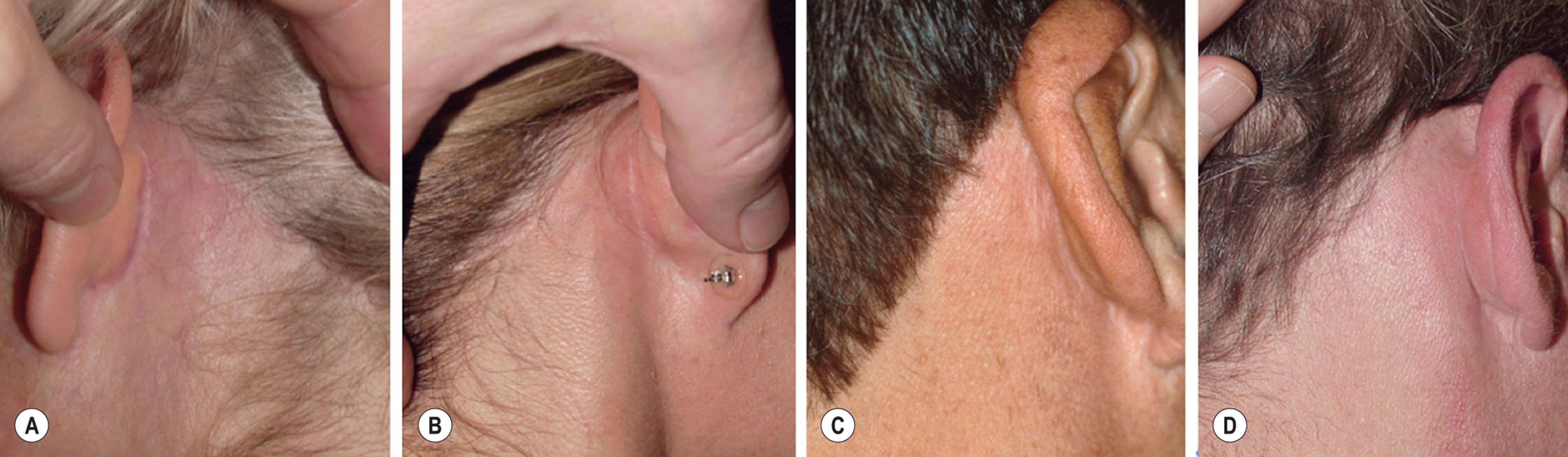 Figure 9.8.25, Healed scars along the occipital hairline. Proper analysis, careful planning, and the use of an incision along the hairline, when indicated will allow skin to be excised along a correct posterior-superior vector, while simultaneously preventing hairline notching and producing a well-concealed scar. (A,B) Healed scars along the occipital hairline in two women. (C,D) Healed scars along the occipital hairline in two men. (Surgery performed by Timothy Marten, MD, FACS).